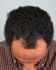 Before Hair Transplant&nbsp;Hairlines